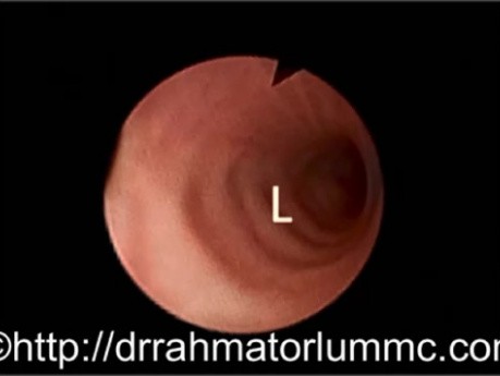 Contraction de la Paroi Bronchique