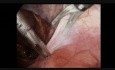 Traitement de la hernie inguinale par coelioscopie. Étape 2: Incision du péritoine à droite