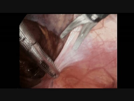 Traitement de la hernie inguinale par coelioscopie. Étape 2: Incision du péritoine à droite