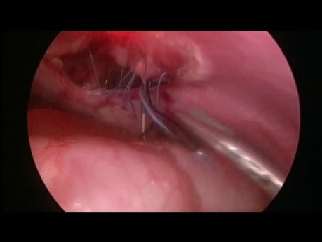 Réparation Laparoscopique de la Hernie de Morgagni Rétrosternale