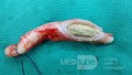 L'appendicite - l'infection provoquée par une obstruction de la lumière de l'appendice. 1
