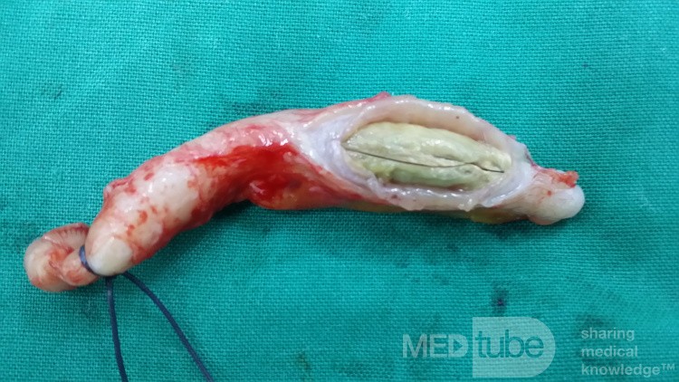 L'appendicite - l'infection provoquée par une obstruction de la lumière de l'appendice. 1