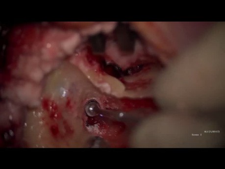 Chirurgie Endoscopique du Cholestéatome avec Oblitération du Mastoïde