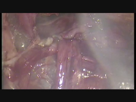 Cure coelioscopique de hernie inguinale congénitale récidivante