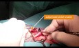 Technique de poche mini-invasive pour attirer l'aimant sans ancrage (Pr. P. Dolhen).