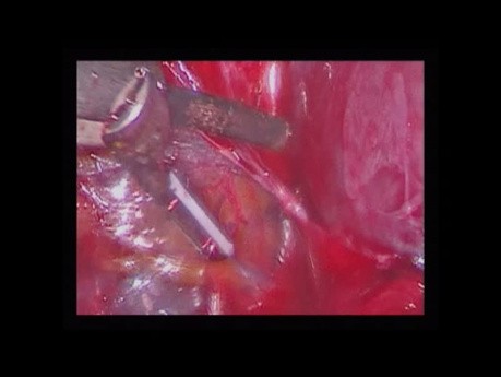 Hystérectomie laparoscopique