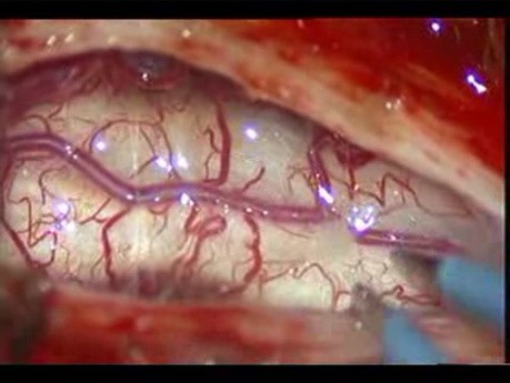 Malformation de Chiari avec Syringomyélie