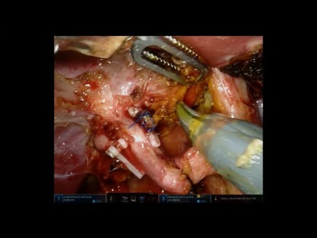 Résection Biliaire Extra-Hépatique Robotique avec Hépatico-Jéjunostomie de Roux-en-Y pour Tumeur de Klatskin type II