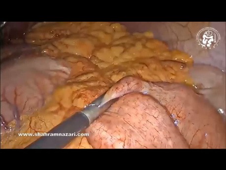 Pontage Gastrique d'Anastomose à Anastomose unique pour Réintervention Chirurgicale après l'Echec d'une Gastrectomie Sleeve