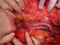 Artère rénale droite précave pendant la lymphadénectomie pour cancer de l'endomètre