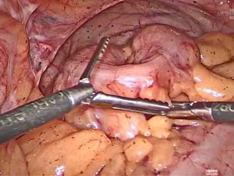 Le Tatouage Endoscopique du Côlon