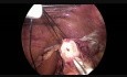 Énucléation laparoscopique du léiomyome de l'œsophage distal. Fundoplicature de Nissen