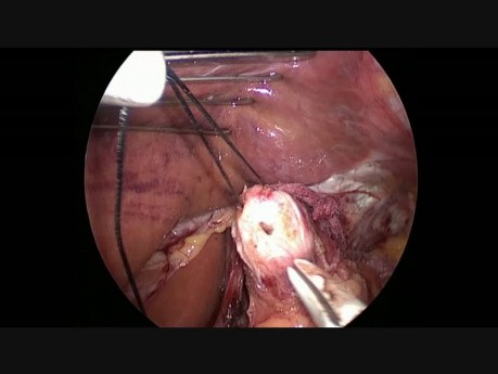 Énucléation laparoscopique du léiomyome de l'œsophage distal. Fundoplicature de Nissen
