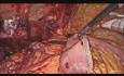 Hépaticojéjunostomie par laparoscopie pour des lésions iatrogènes de conduit cholédoque