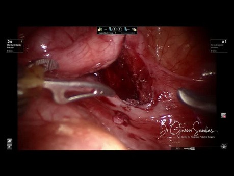 Chirurgie robot-assistée pour l'uretère ectopique chez un enfant de 4 ans