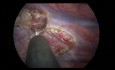 Sympathectomie Thoracique Endoscopique Bilatérale pour Hyperhidrose Primaire