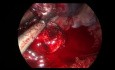 Bilobectomie droite intrapéricardique à double manchon - chirurgie thoracique vidéo-assistée (CTVA) à l'incision unique