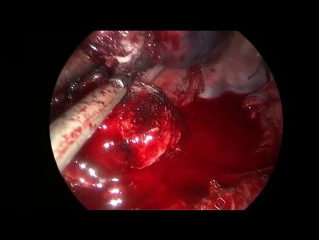 Bilobectomie droite intrapéricardique à double manchon - chirurgie thoracique vidéo-assistée (CTVA) à l'incision unique
