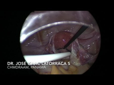 Utilité de la laparoscopie dans la mise en place d'un cathéter de type Tenckhoff