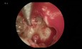 Chirurgie du Cholestéatome (Endoscopique et Microscopique)