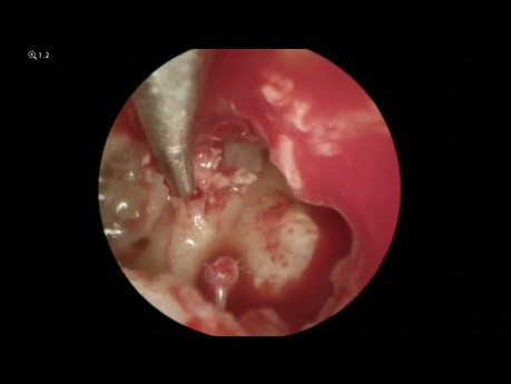 Chirurgie du Cholestéatome (Endoscopique et Microscopique)