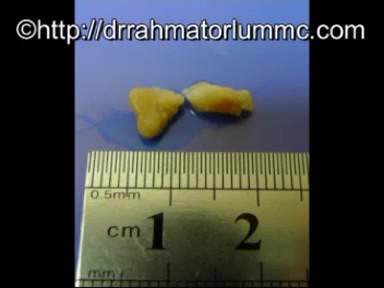 Les Cryptes Amygdaliens - Élimination de Substance Caséeuse 