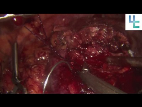 Néphrectomie partielle avec clampage artériel sélectif en cas du rein unique