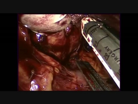 Splénectomie laparoscopique assistée à la main: comment éviter la conversion en laparotomie dans un cas difficile