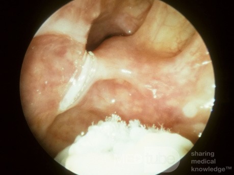Fongus du sinus maxillaire