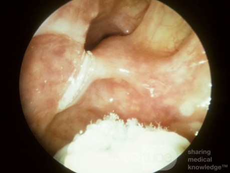 Fongus du sinus maxillaire