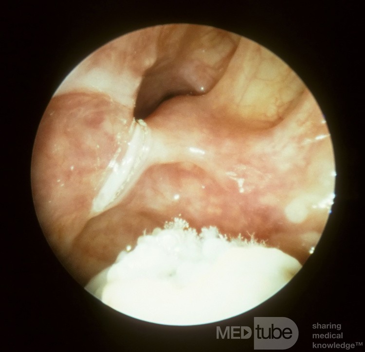 Fongus du sinus maxillaire