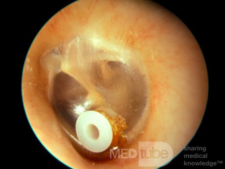 Tube de ventilation avec petite croûte