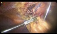 Chirurgie Abdominale Supérieure Antérieure pendant une Cholécystectomie Laparoscopique