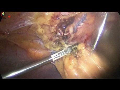 Chirurgie Abdominale Supérieure Antérieure pendant une Cholécystectomie Laparoscopique