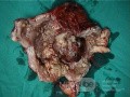 Le tumeur mixte mésodermique maligne. L' utérus.    1