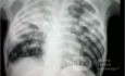 Tuberculose - radiographie thoracique