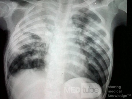Tuberculose - radiographie thoracique