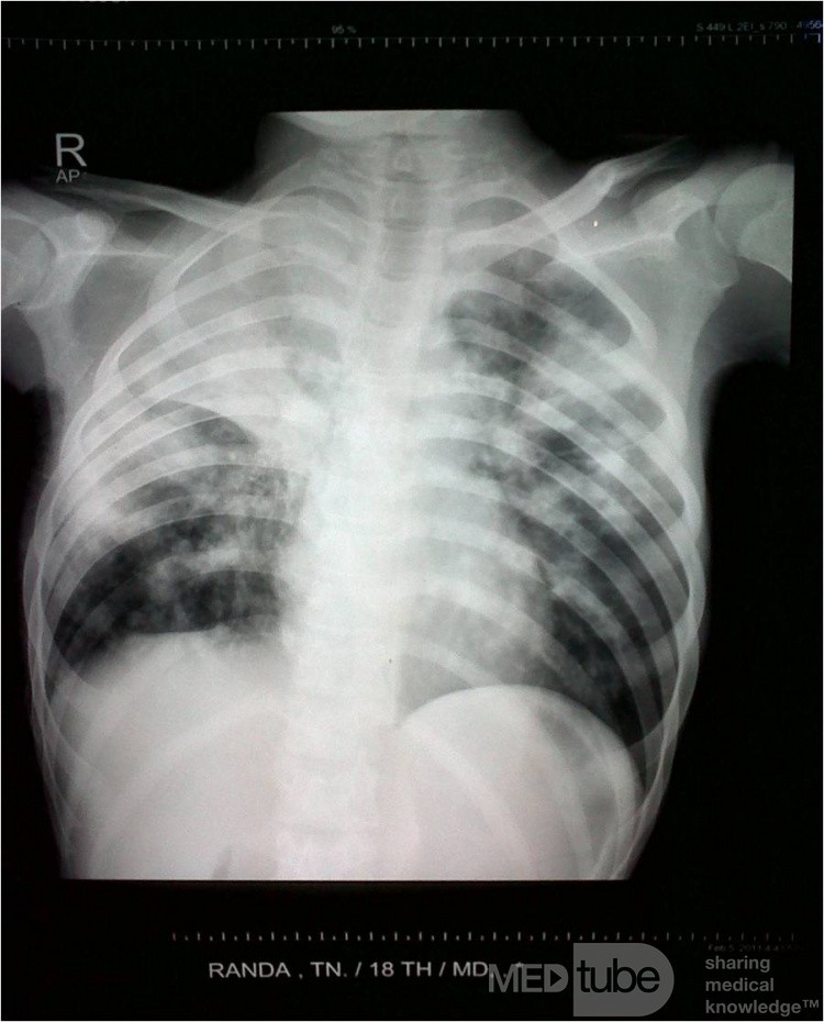 Tuberculose - radiographie thoracique