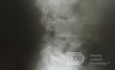 Métastases Lombaires de Cystadénocarcinome Pancréatique