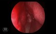 Résection endoscopique d'adénome hypophysaire