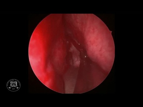 Résection endoscopique d'adénome hypophysaire