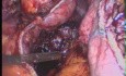Conversion de la gastroplastie à bandes verticales à la gastrectomie en manchon