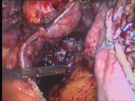 Conversion de la gastroplastie à bandes verticales à la gastrectomie en manchon
