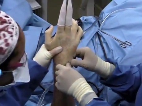 Arthroscopie du Poignet - Réparation du Cartilage