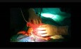 Salpingectomie prophylactique pendant la césarienne