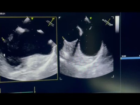 15. Cas d'échocardiographie - Qu'est ce que vous voyez ?