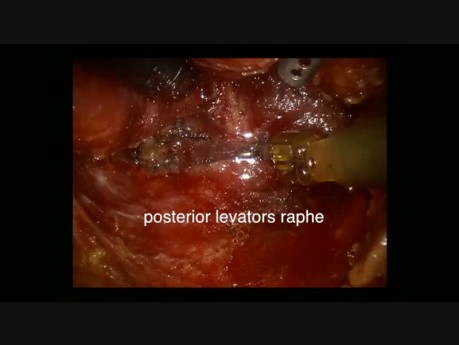 APR robotique - Modification de la technique ELAPE