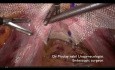 Pectopexie pour Prise en Charge de Prolapsus Urogénital