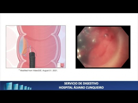 ESD d'une lésion gastrique. Utilisation du fil de traction