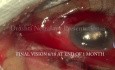 Prise en charge d'une endophtalmite traumatique